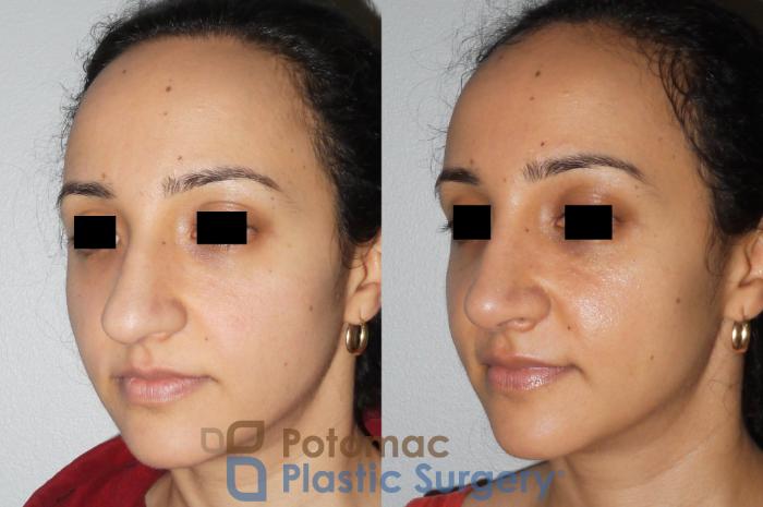 Before & After Rhinoplasty - Cosmetic Case 82 Left Oblique View in Washington DC & Arlington , DC