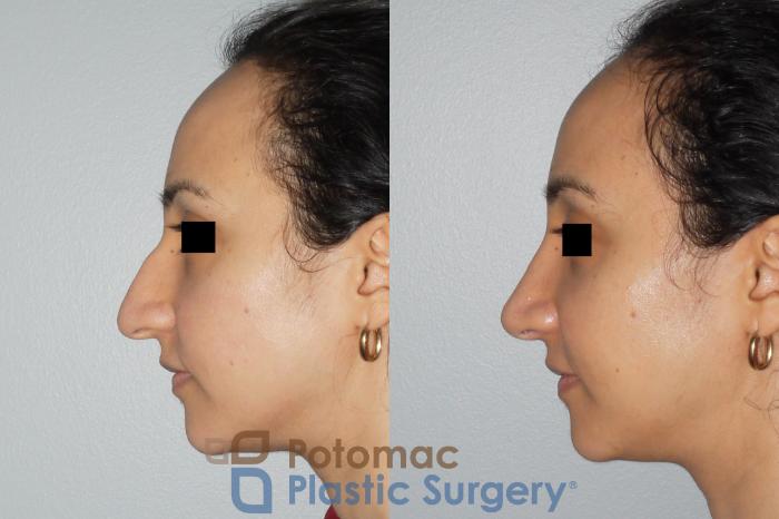 Before & After Rhinoplasty - Cosmetic Case 82 Left Side View in Washington DC & Arlington , DC