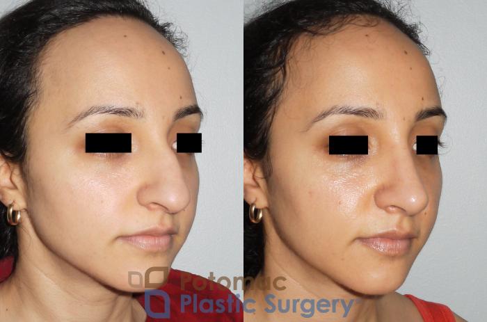 Before & After Rhinoplasty - Cosmetic Case 82 Right Oblique View in Washington DC & Arlington , DC