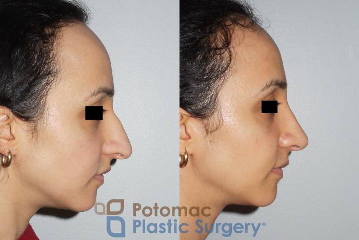 Before & After Rhinoplasty - Cosmetic Case 82 Right Side View in Washington DC & Arlington , DC