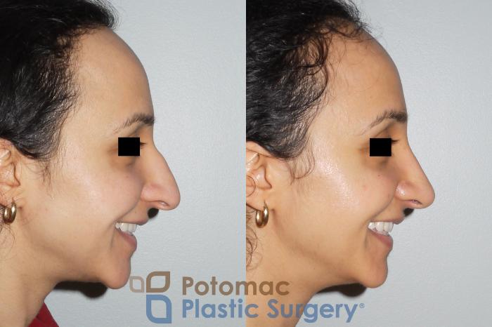 Before & After Rhinoplasty - Medical Case 82 Right Side View #2 View in Washington DC & Arlington , DC