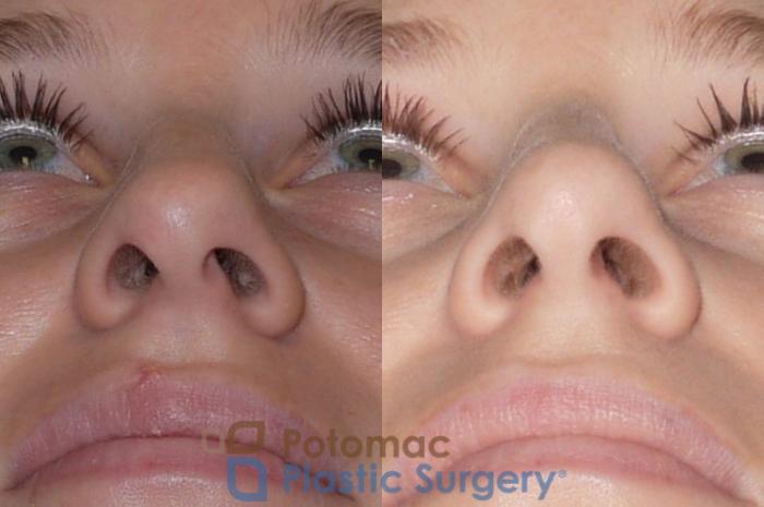 Before & After Rhinoplasty - Cosmetic Case 83 Below View in Washington DC & Arlington , DC