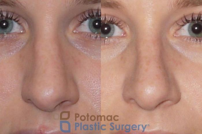 Before & After Rhinoplasty - Medical Case 83 Front View in Washington DC & Arlington , DC