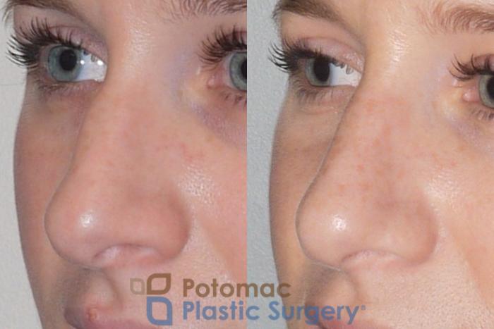 Before & After Rhinoplasty - Medical Case 83 Left Oblique View in Washington DC & Arlington , DC