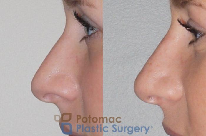 Before & After Rhinoplasty - Cosmetic Case 83 Left Side View in Washington DC & Arlington , DC