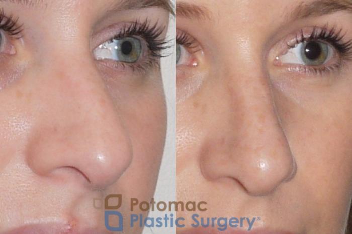Before & After Rhinoplasty - Cosmetic Case 83 Right Oblique View in Washington DC & Arlington , DC