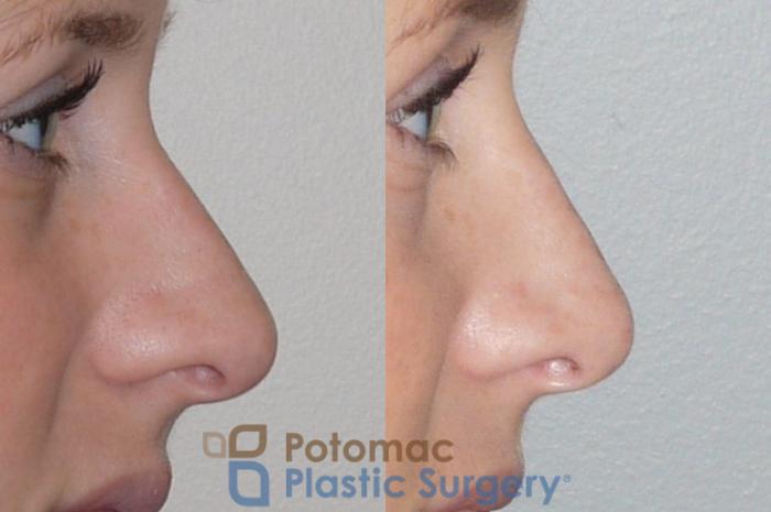 Before & After Rhinoplasty - Cosmetic Case 83 Right Side View in Washington DC & Arlington , DC