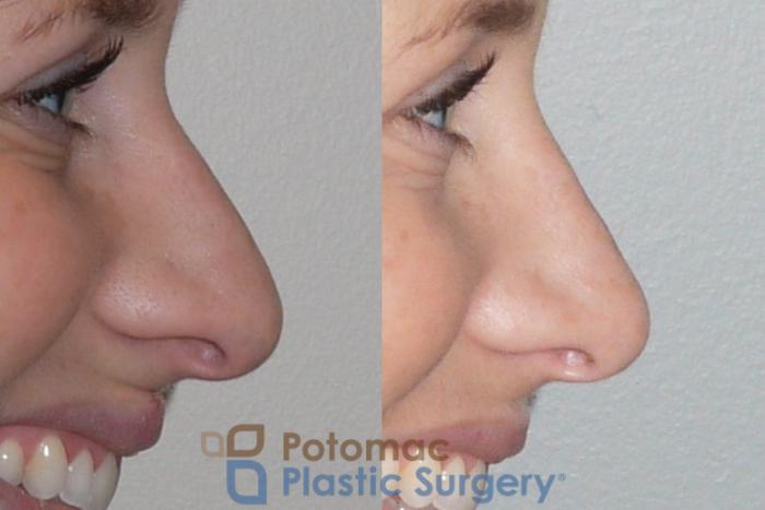 Before & After Rhinoplasty - Cosmetic Case 83 Right Side View #2 View in Washington DC & Arlington , DC