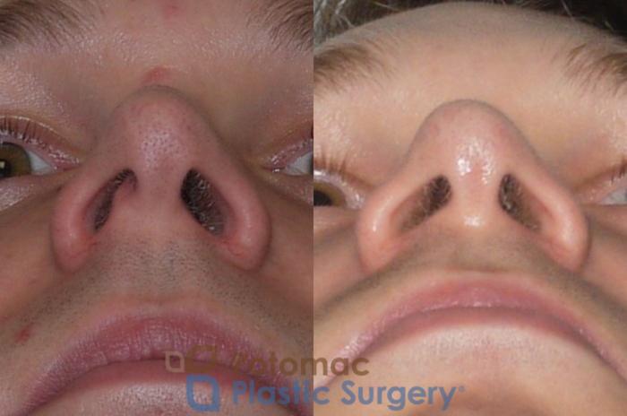 Before & After Rhinoplasty - Medical Case 84 Below View in Washington DC & Arlington , DC