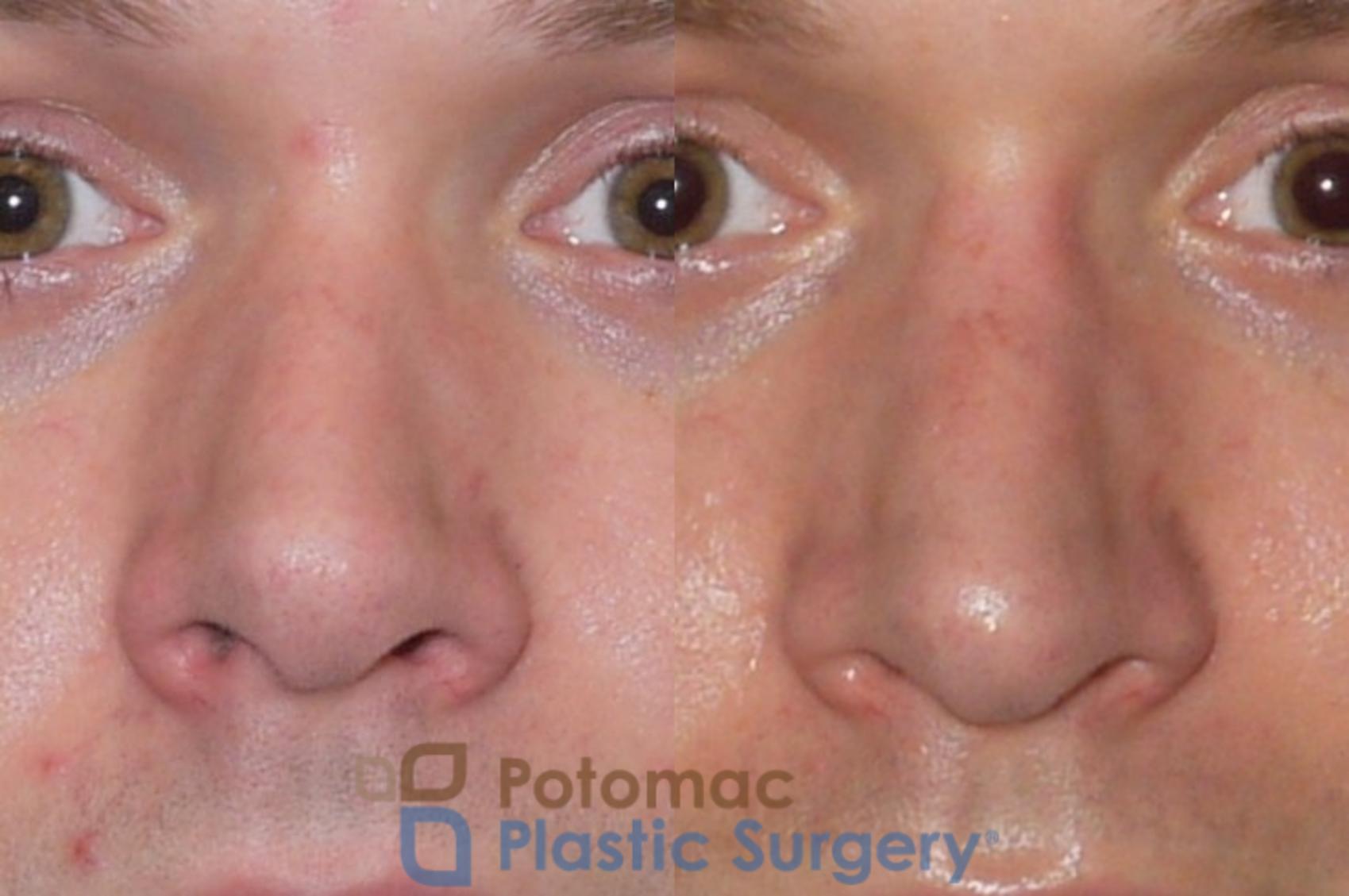Before & After Rhinoplasty - Medical Case 84 Front View in Washington, DC