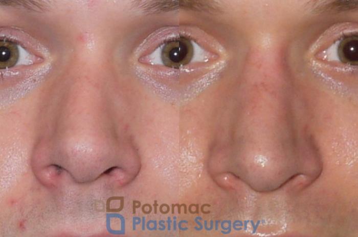 Before & After Rhinoplasty - Medical Case 84 Front View in Washington DC & Arlington , DC