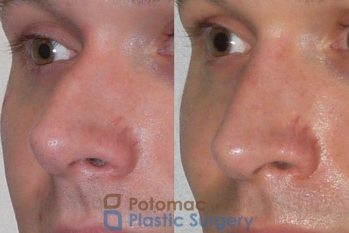 Before & After Rhinoplasty - Medical Case 84 Left Oblique View in Washington DC & Arlington , DC