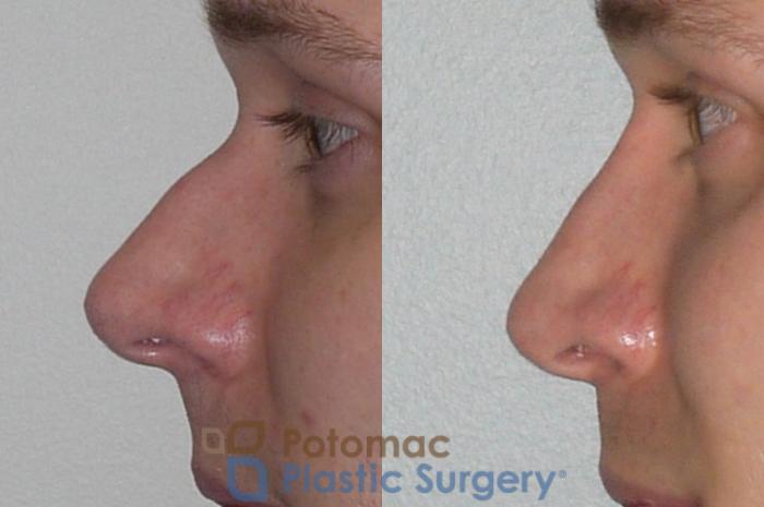Before & After Rhinoplasty - Medical Case 84 Left Side View in Washington DC & Arlington , DC