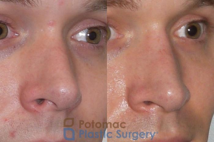 Before & After Rhinoplasty - Medical Case 84 Right Oblique View in Washington DC & Arlington , DC