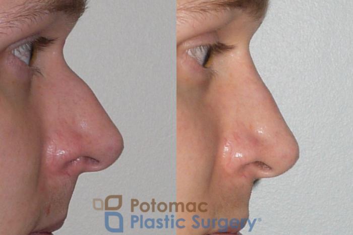 Before & After Rhinoplasty - Cosmetic Case 84 Right Side View in Washington DC & Arlington , DC