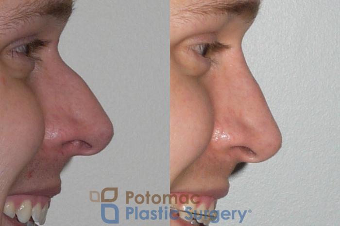 Before & After Rhinoplasty - Cosmetic Case 84 Right Side View #2 View in Washington DC & Arlington , DC