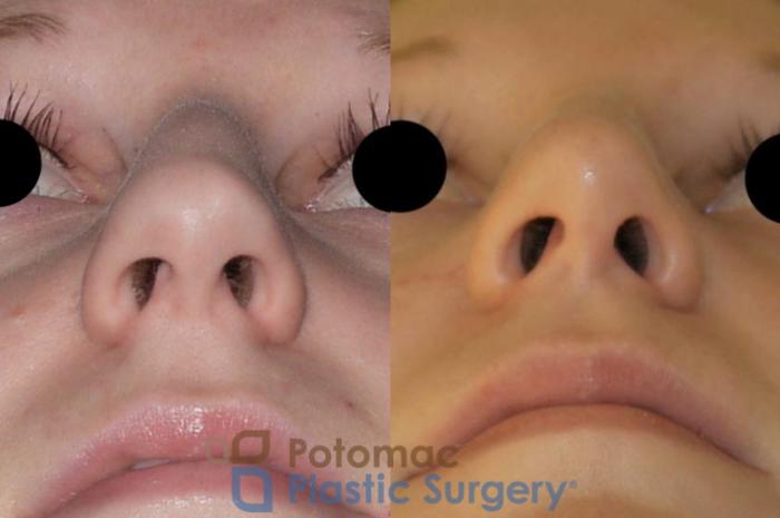 Before & After Rhinoplasty - Cosmetic Case 86 Below View in Washington DC & Arlington , DC