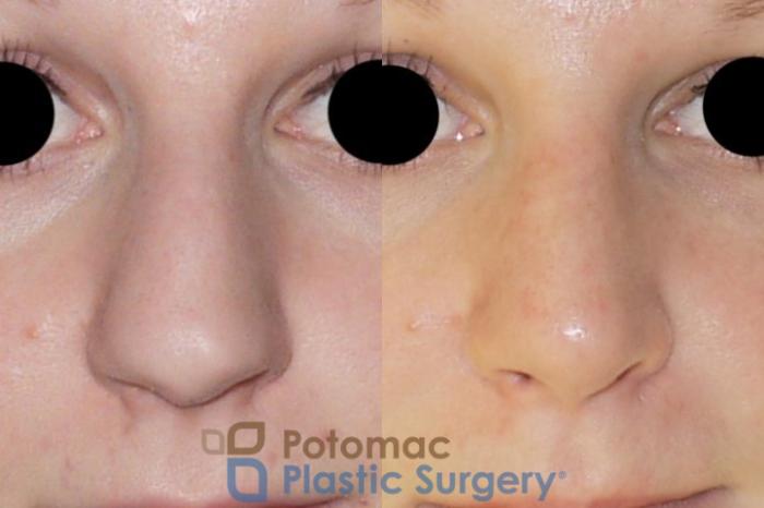 Before & After Rhinoplasty - Cosmetic Case 86 Front View in Washington DC & Arlington , DC