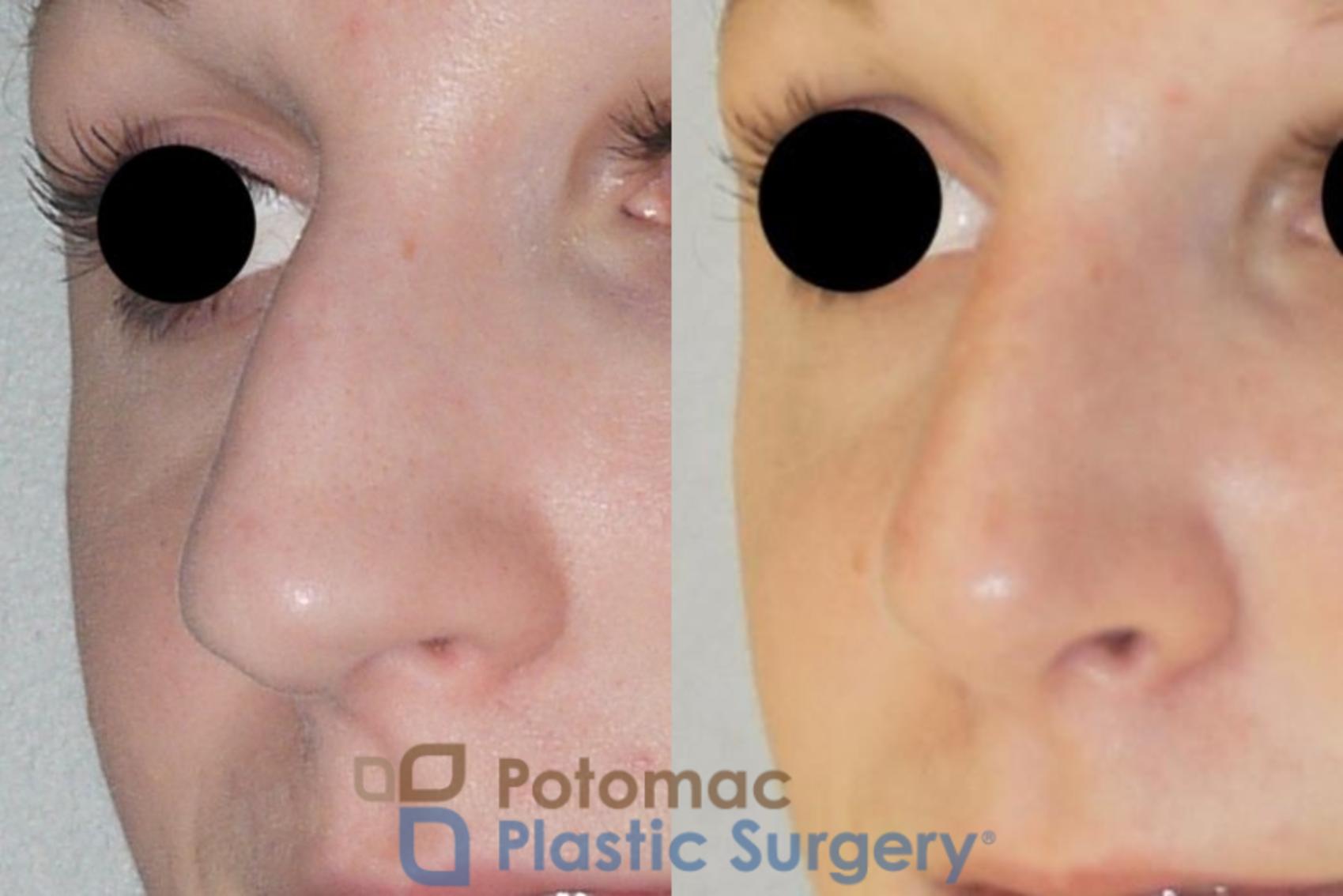 Before & After Rhinoplasty - Cosmetic Case 86 Left Oblique View in Washington, DC