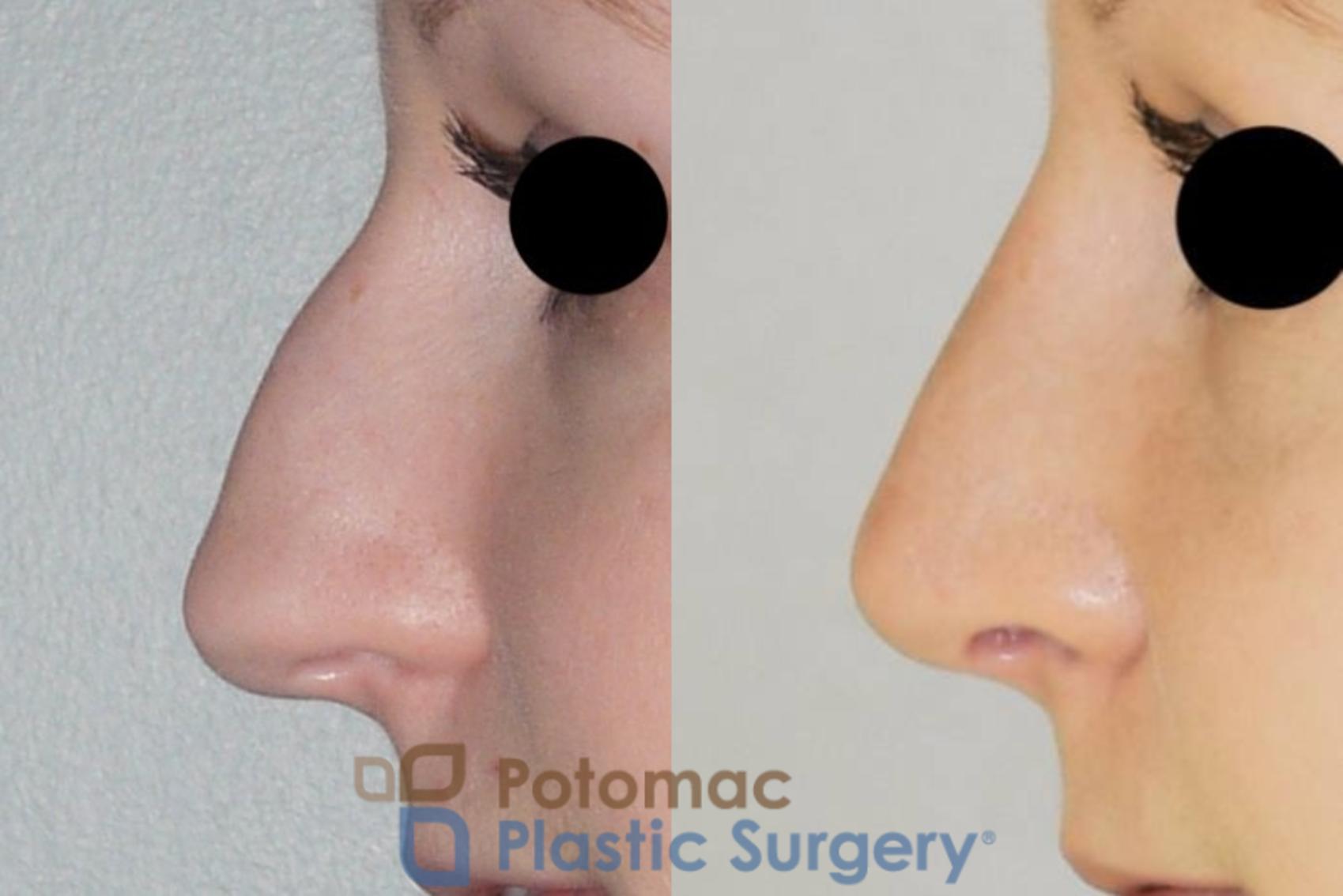 Before & After Rhinoplasty - Cosmetic Case 86 Left Side View in Washington, DC