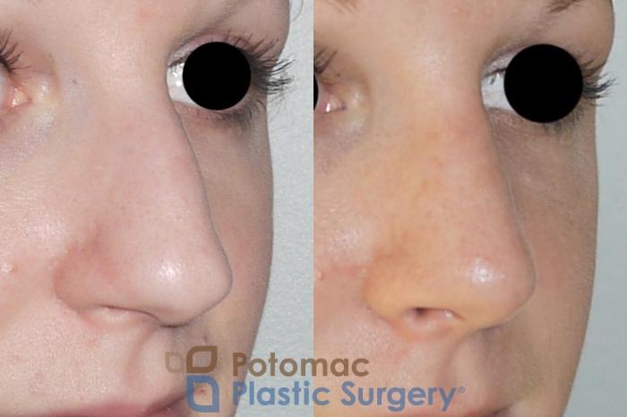 Before & After Rhinoplasty - Cosmetic Case 86 Right Oblique View in Washington DC & Arlington , DC
