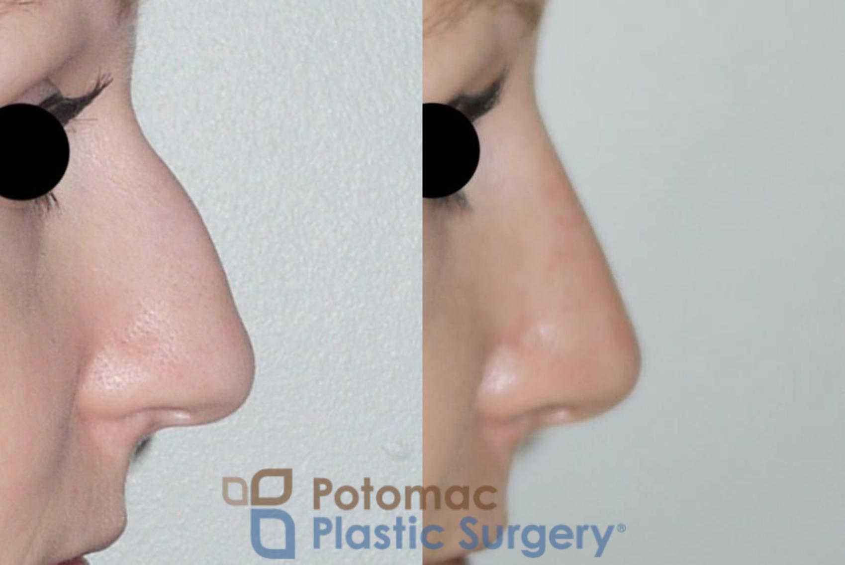 Before & After Rhinoplasty - Cosmetic Case 86 Right Side View #1 View in Washington, DC