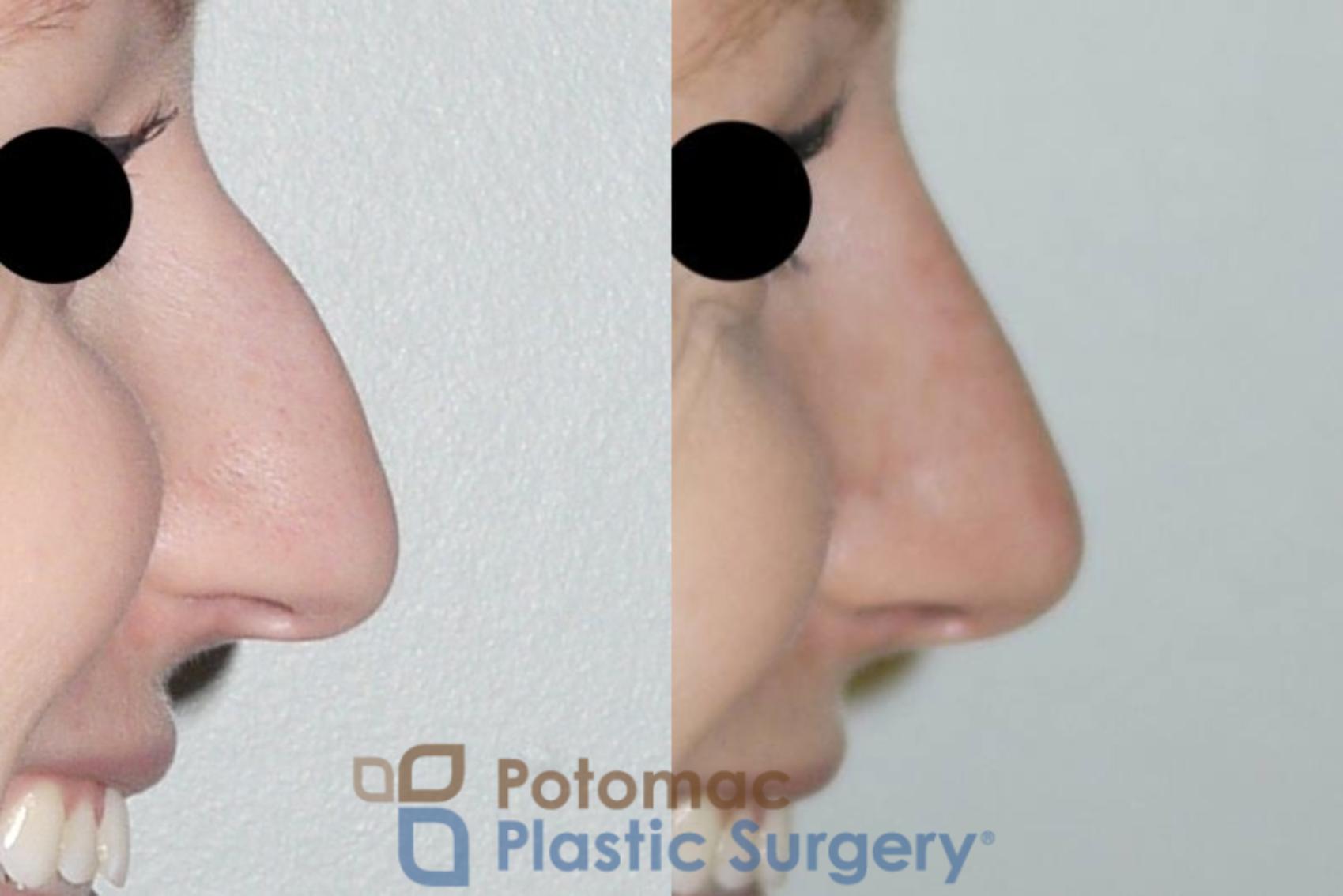 Before & After Rhinoplasty - Cosmetic Case 86 Right Side View #2 View in Washington, DC