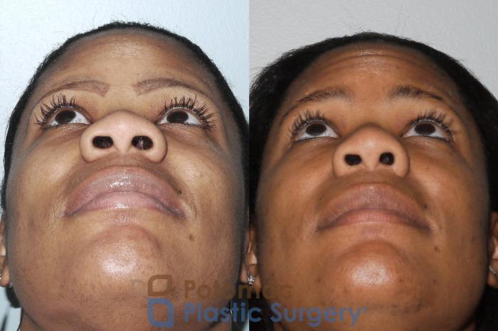 Before & After Rhinoplasty - Cosmetic Case 88 Bottom View in Washington DC & Arlington , DC