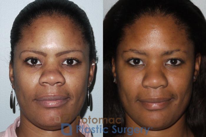 Before & After Rhinoplasty - Cosmetic Case 88 Front View in Washington DC & Arlington , DC
