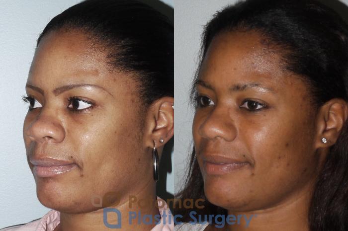 Before & After Rhinoplasty - Cosmetic Case 88 Left Oblique View in Washington DC & Arlington , DC