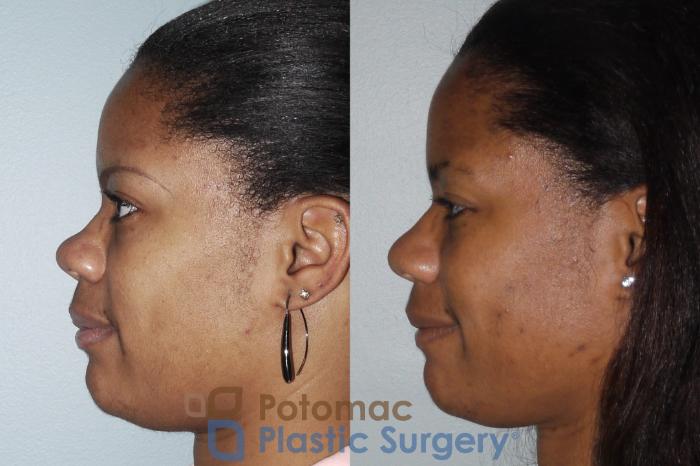 Before & After Rhinoplasty - Cosmetic Case 88 Left Side View in Washington DC & Arlington , DC