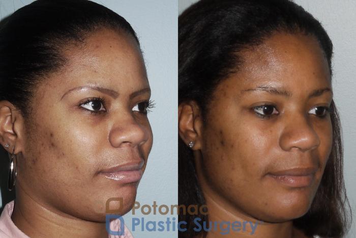 Before & After Rhinoplasty - Cosmetic Case 88 Right Oblique View in Washington DC & Arlington , DC