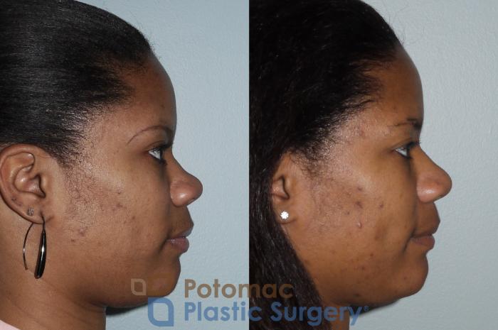 Before & After Rhinoplasty - Cosmetic Case 88 Right Side View in Washington DC & Arlington , DC