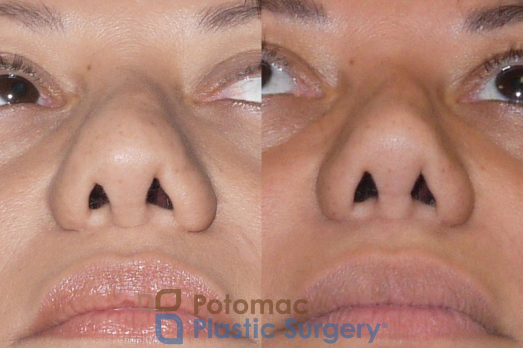 Before & After Rhinoplasty - Cosmetic Case 91 Below View in Washington DC & Arlington , DC