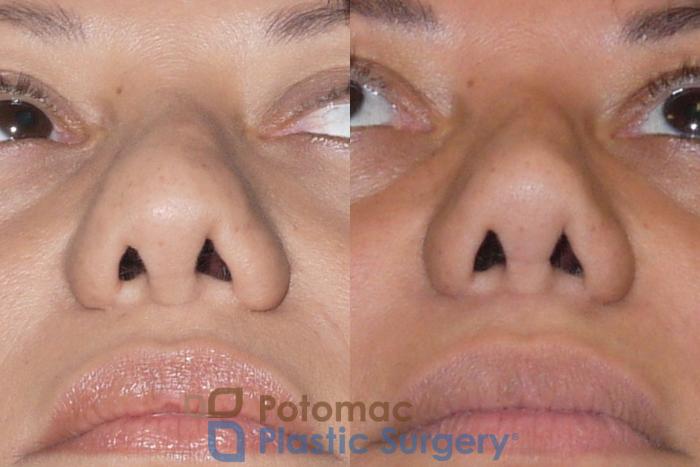 Before & After Rhinoplasty - Cosmetic Case 91 Below View in Washington DC & Arlington , DC