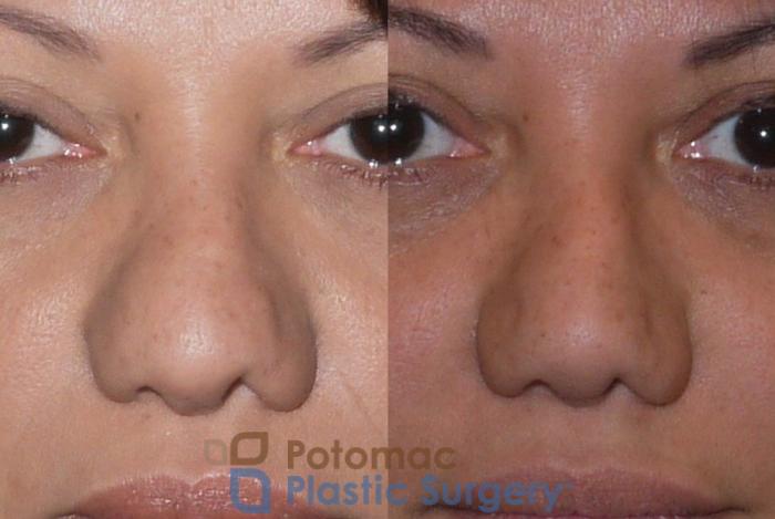 Before & After Rhinoplasty - Cosmetic Case 91 Front View in Washington DC & Arlington , DC