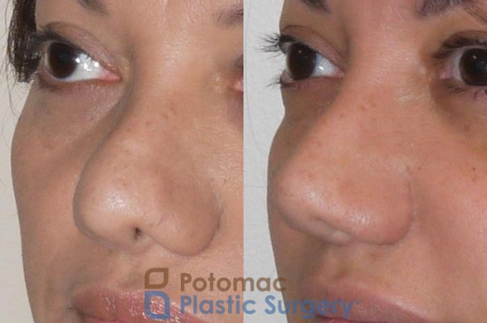 Before & After Rhinoplasty - Cosmetic Case 91 Left Oblique View in Washington DC & Arlington , DC