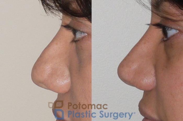 Before & After Rhinoplasty - Cosmetic Case 91 Left Side View in Washington DC & Arlington , DC