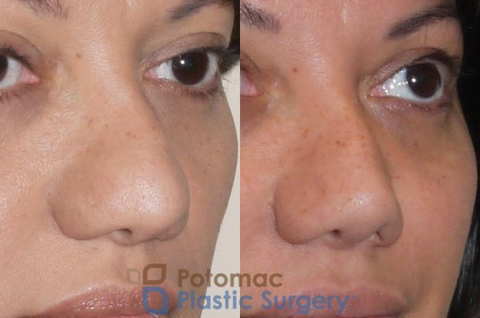 Before & After Rhinoplasty - Cosmetic Case 91 Right Oblique View in Washington DC & Arlington , DC