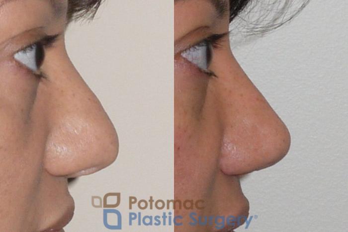 Before & After Rhinoplasty - Cosmetic Case 91 Right Side View in Washington DC & Arlington , DC