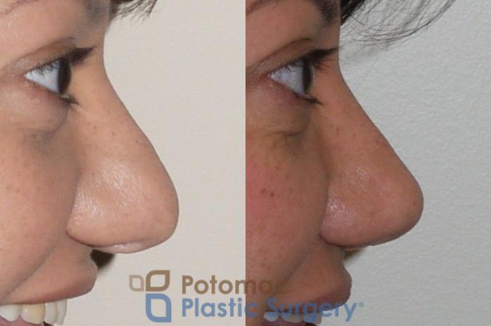 Before & After Rhinoplasty - Cosmetic Case 91 Right Side View #2 View in Washington DC & Arlington , DC