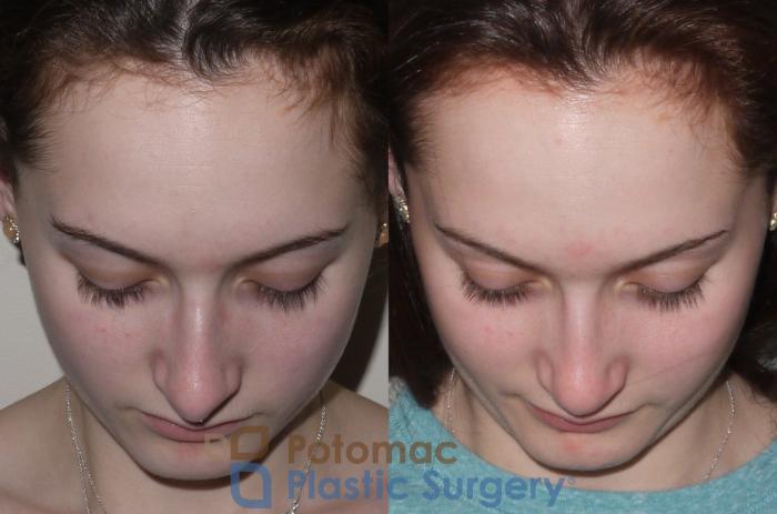 Before & After Rhinoplasty - Medical Case 94 Above View in Washington DC & Arlington , DC