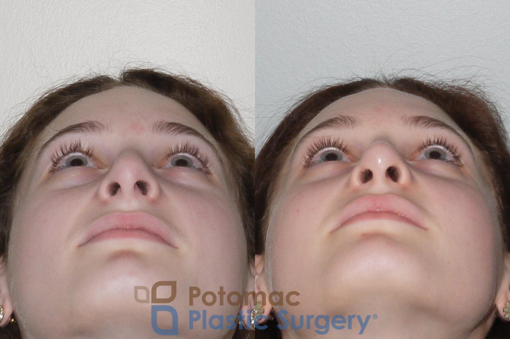 Before & After Rhinoplasty - Cosmetic Case 94 Below View in Washington DC & Arlington , DC