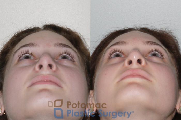 Before & After Rhinoplasty - Medical Case 94 Below View in Washington DC & Arlington , DC