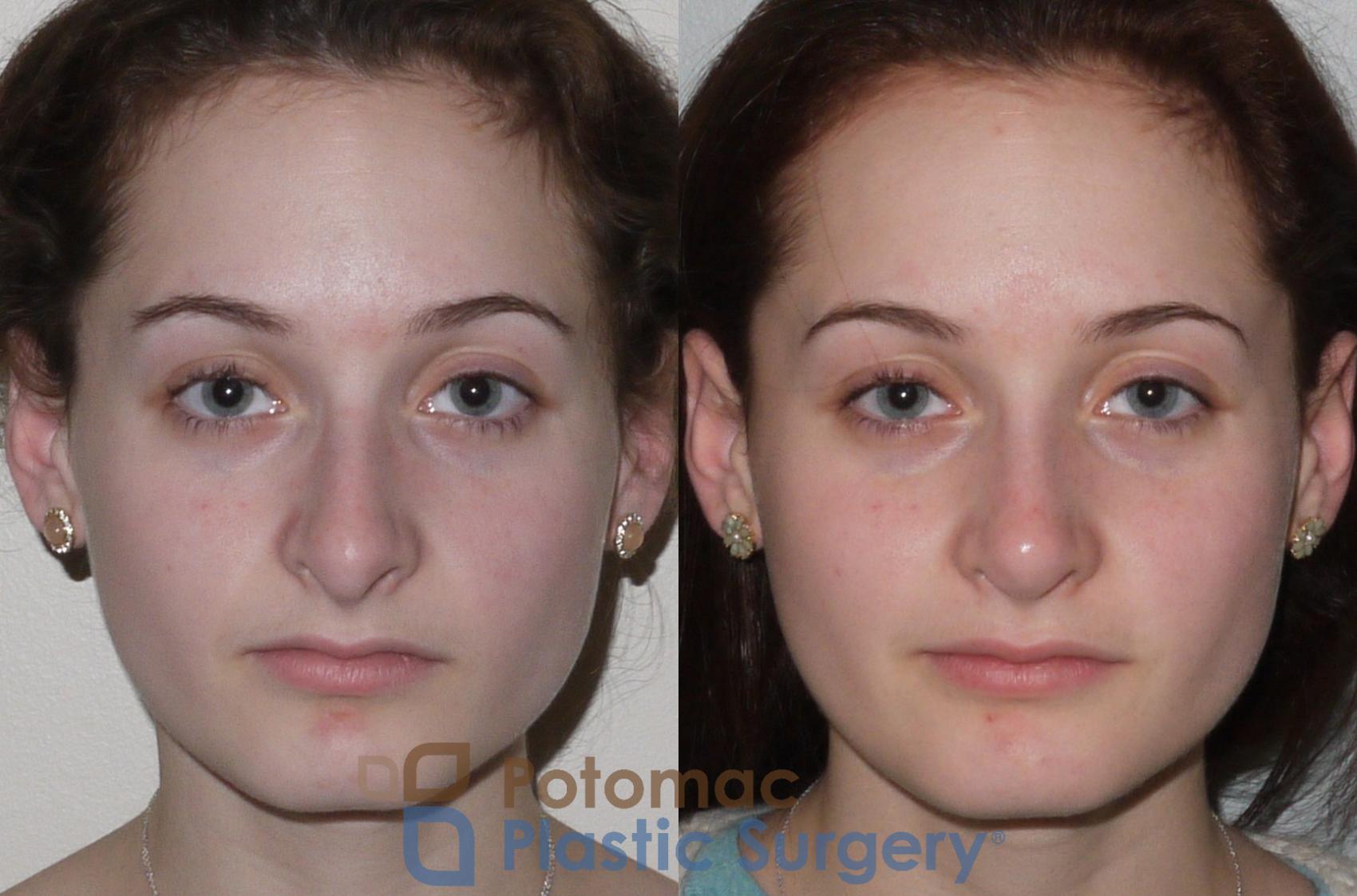 Before & After Rhinoplasty - Medical Case 94 Front View in Washington DC & Arlington , DC