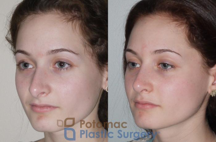 Before & After Rhinoplasty - Cosmetic Case 94 Left Oblique View in Washington DC & Arlington , DC