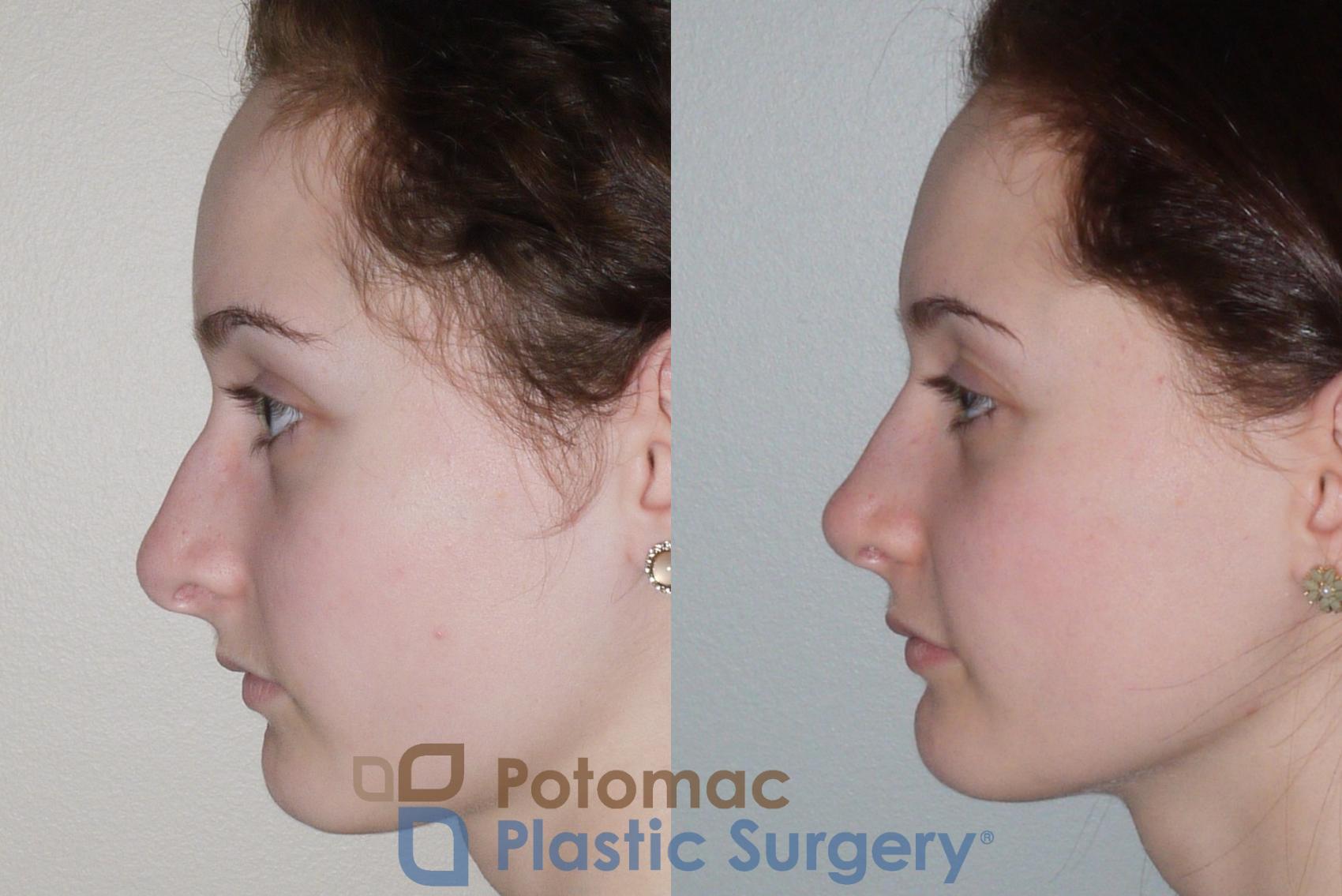 Before & After Rhinoplasty - Cosmetic Case 94 Left Side View in Washington DC & Arlington , DC