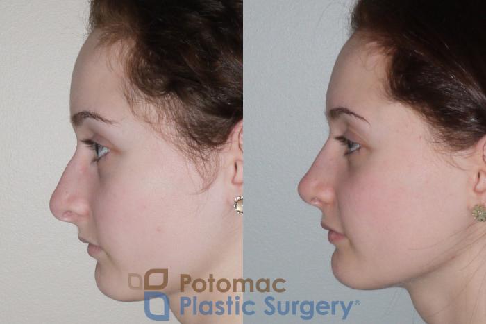 Before & After Rhinoplasty - Medical Case 94 Left Side View in Washington DC & Arlington , DC