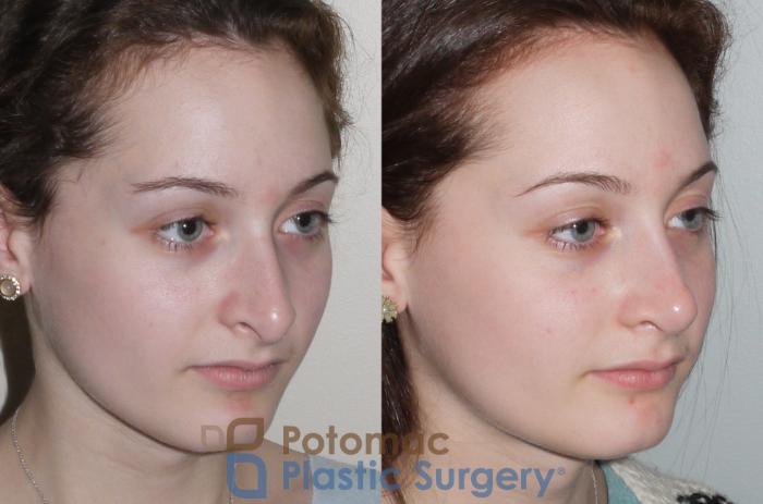 Before & After Rhinoplasty - Cosmetic Case 94 Right Oblique View in Washington DC & Arlington , DC