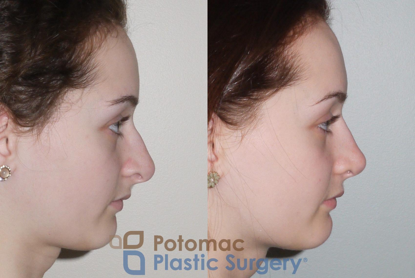 Before & After Rhinoplasty - Cosmetic Case 94 Right Side View in Washington DC & Arlington , DC